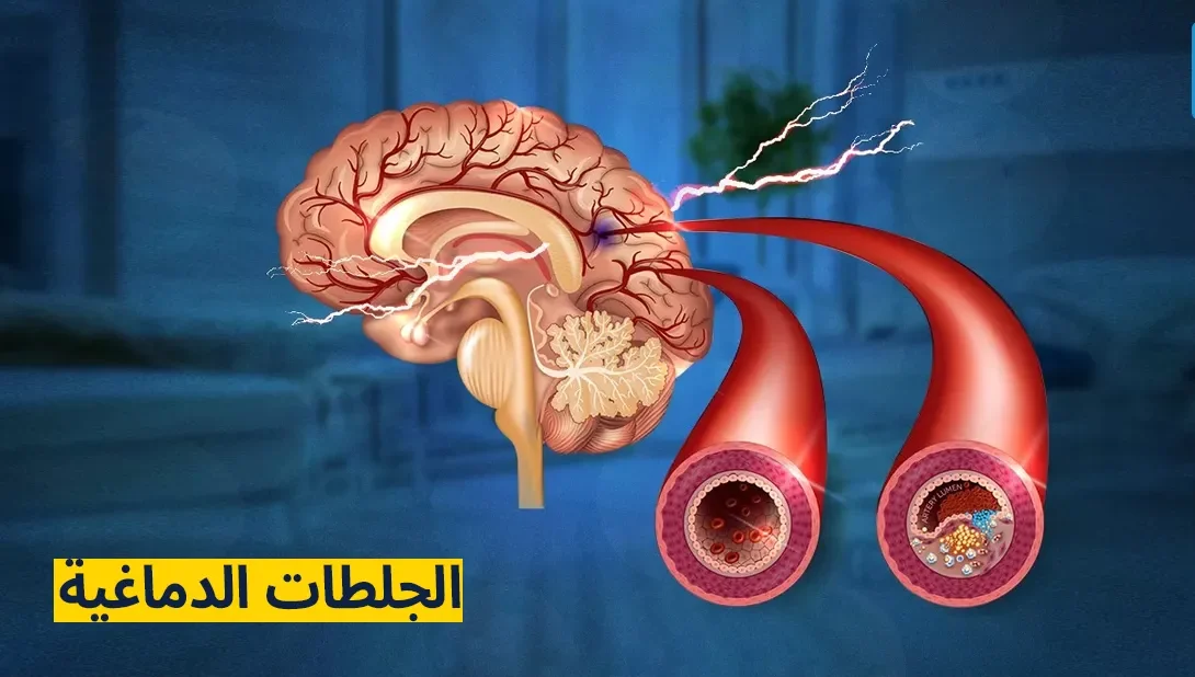 علاج الجلطات في تونس: رعاية متقدّمة وكوادر طبية خبيرة